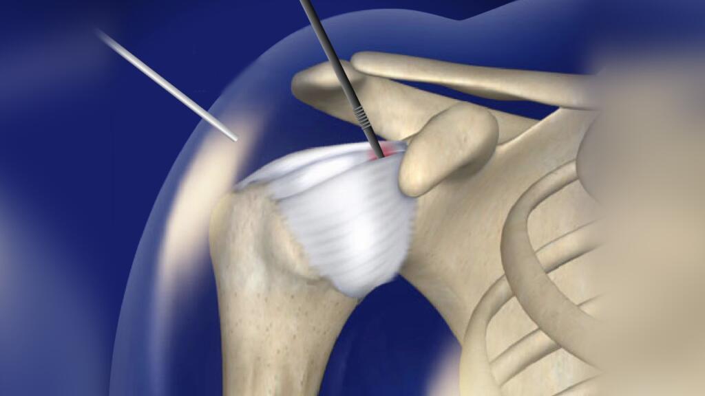 آرتروسکوپی شانه چگونه انجام میگیرد و چه مزایایی نسبت به جراحی باز دارد؟ آرتروسکوپی شانه