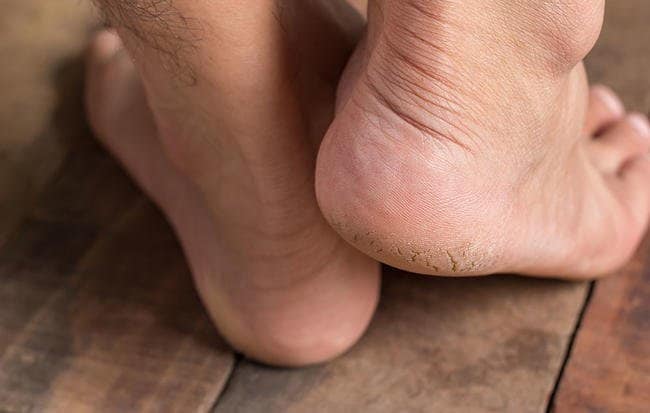 ترک پاشنه پا و زخمهای ترک پاشنه پا  ترک پاشنه پا