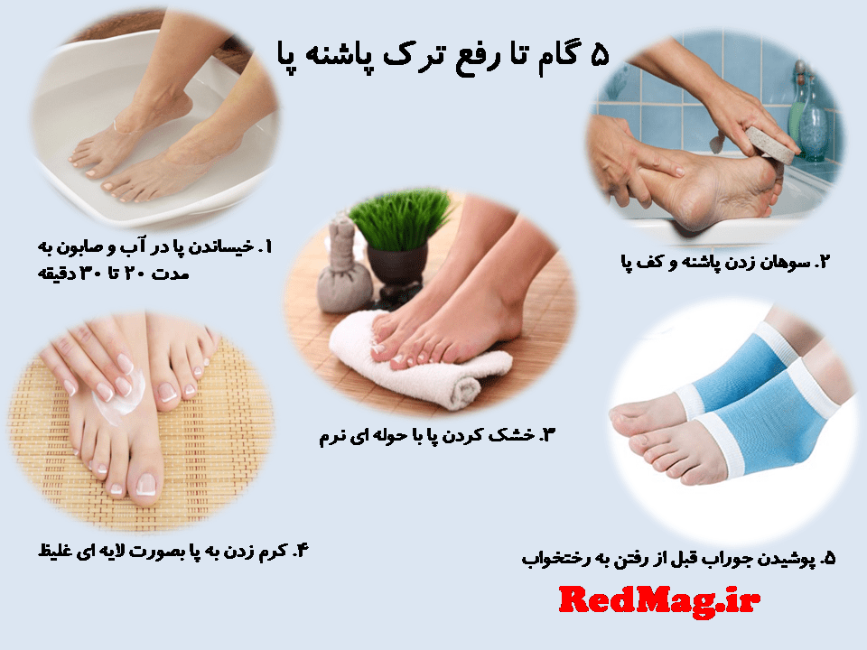 درمان ترک پاشنه پا در چند مرحله آسان درمان ترک پاشنه پا در 5 مرحله آسان